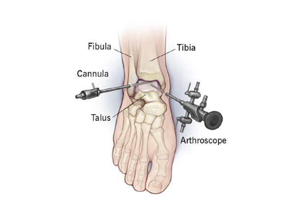 Ankle Arthroscopic Surgery